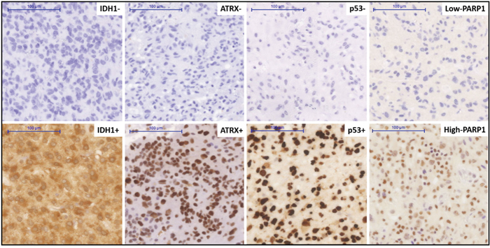 Immunohistochemical staining pattern for various markers in a clinical cohort of glioblastoma.