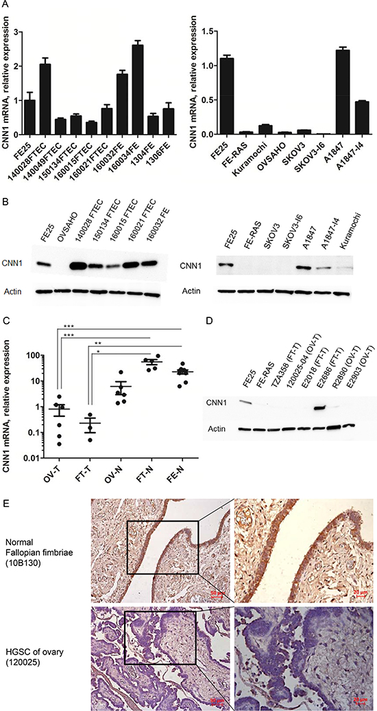 CNN1 is downregulated in the development of HGSC and in invasion progression of ovarian cancer cells.
