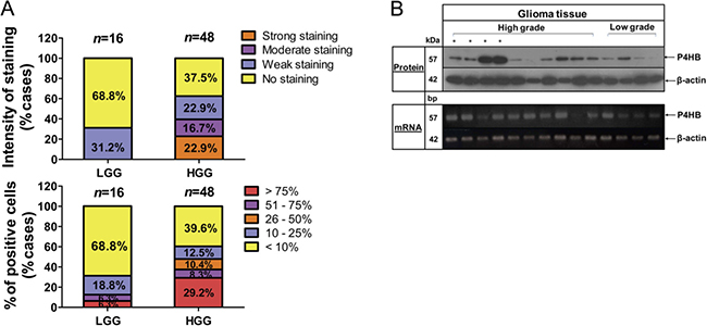 Upregulation of P4HB is associated with high grade glioma.