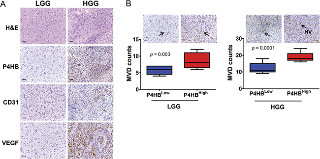 P4HB plays roles in glioma angiogenesis.