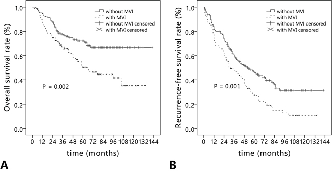 Long-term outcomes in hepatocellular carcinoma patients with (n = 87) and without microvascular invasion (n = 146).