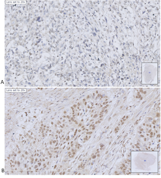 Immunohistochemical staining of hMex-3A in human bladder cancers.