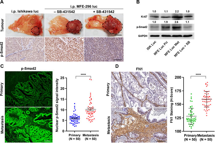 Up-regulation of TGF-&#x3b2; signalling at metastatic sites in an