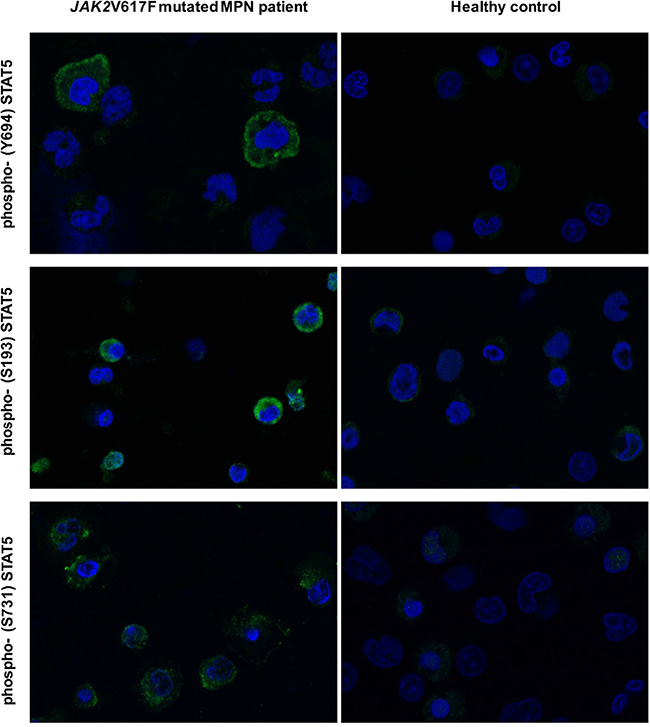 Autonomous phosphorylation of STAT5 residues Y694, S193 and S731 in untouched granulocytes from a JAK2V617F mutated patients with myelofibrosis, analyzed by confocal microscopy.