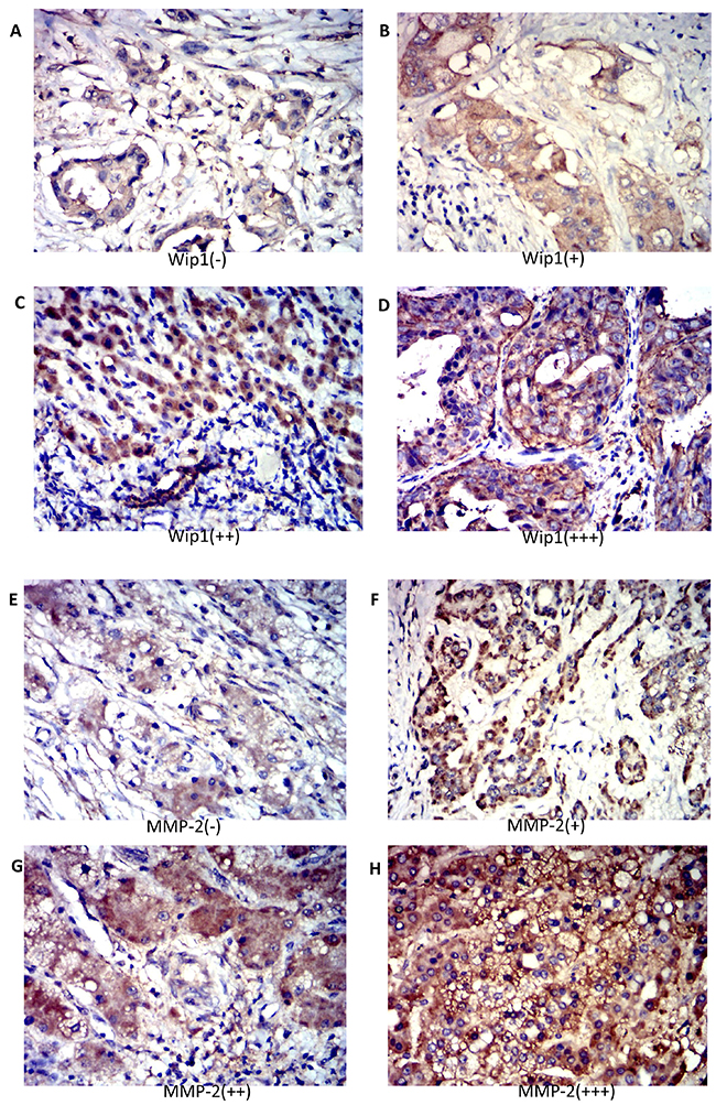 Expression of Wip1 and MMP-2 in human ICC tissues.