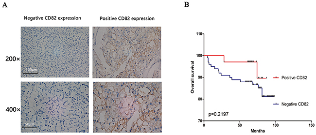 RCC tissues in two human RCC TMAs were used to assess the relationship between CD82 and clinic factors of RCC.