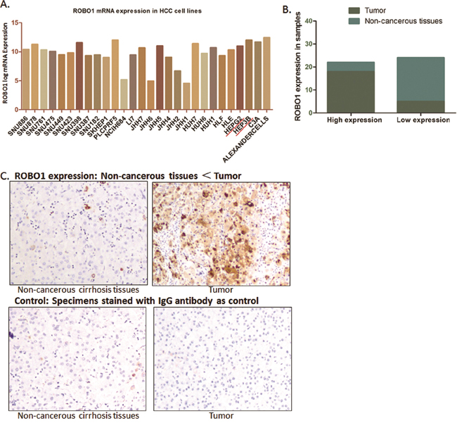 ROBO1 expression in HCC cell lines and real patients&#x2019; specimens.