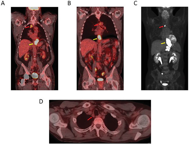 A PET-CT image showing a lower esophageal/GEJ primary cancer.