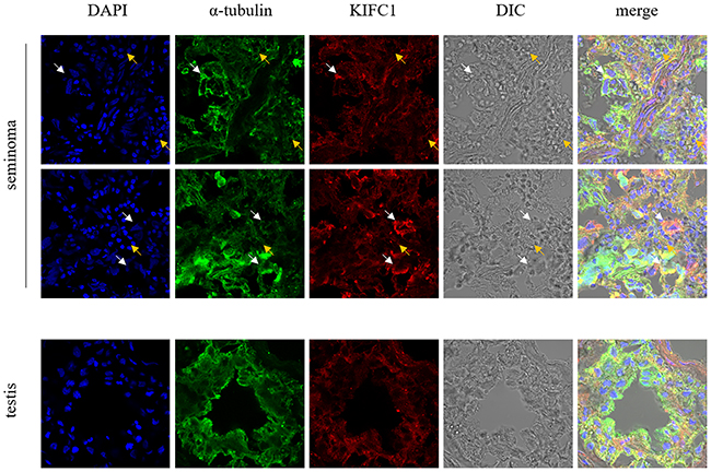 Localization of KIFC1 in seminoma tissue samples and nearby testis tissue samples from human determined by immuno-florescent staining.