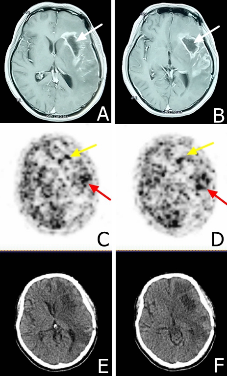 MRI and EGFR-18F-FDG and PET/CT scans in a male patient presented with glioblastoma multiforme at eight months following surgical resection.