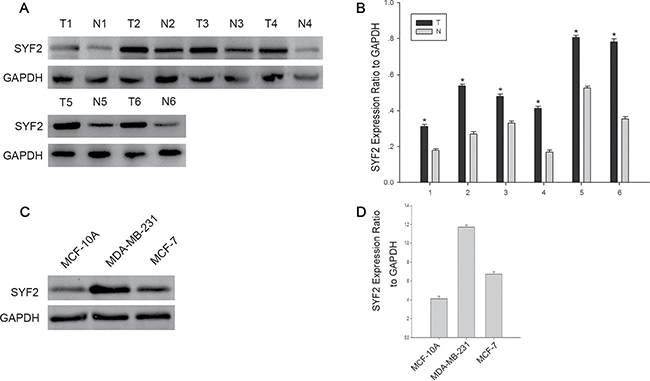 The expression of SYF2 in bresat cancer tissues and cells.
