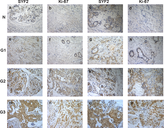 The paraffin-embedded BC tissues were stained with antibodies for SYF2 and Ki-67 and counterstained with hematoxylin (detailed in the &#x201C;Materials and methods&#x201D; section).