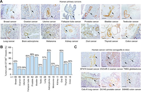 Pericytes expressing GT198 are common in human primary cancers and xenograft mouse tumors.