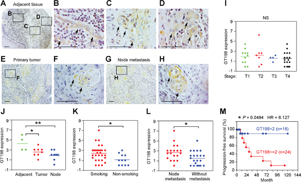 GT198+ pericytes give rise to tumor cells in human oral cancer.