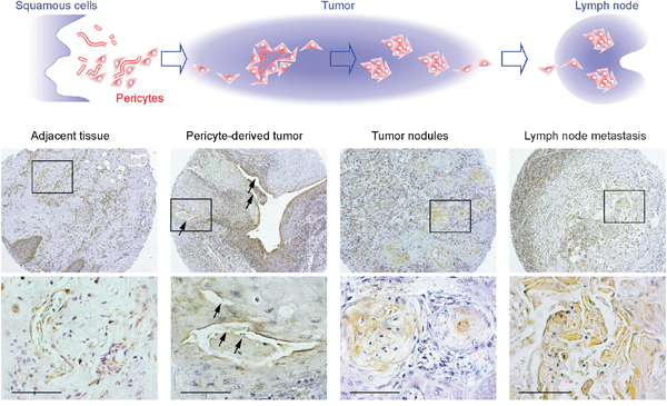 GT198+ pericytes give rise to pericyte-derived tumor cells which migrate into lymph node.