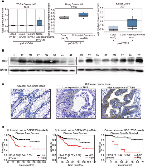 TRIB1 is frequently amplified and overexpressed in human colorectal cancer (CRC) tissues.