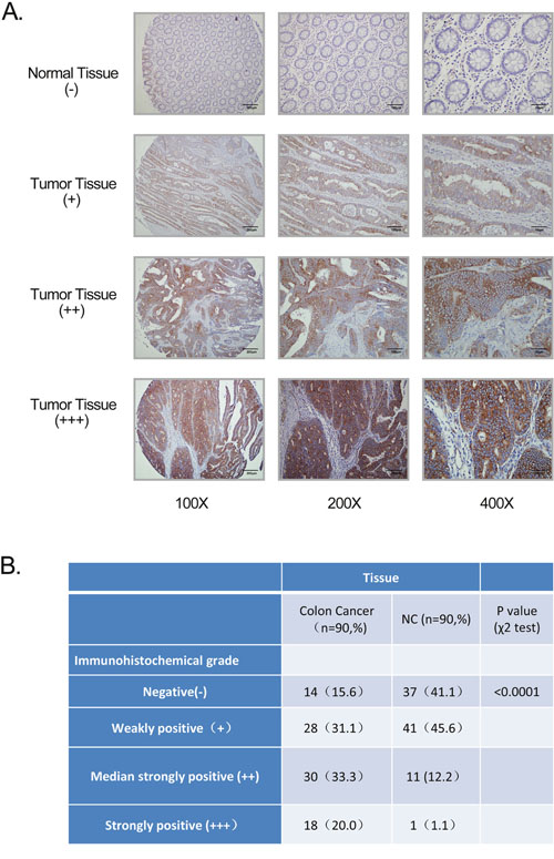 GPR116 expression in colon cancer tissue samples.