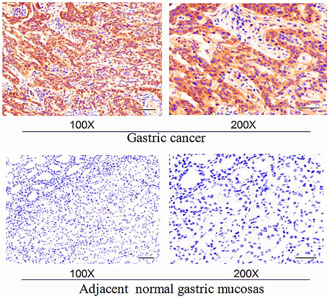 Representative expression levels of EphA2 in gastric cancer and adjacent normal gastric mucosa following immunohistochemisty.
