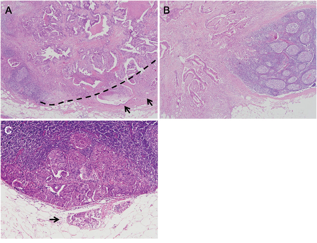 Representative examples of lymph node metastasis patterns.