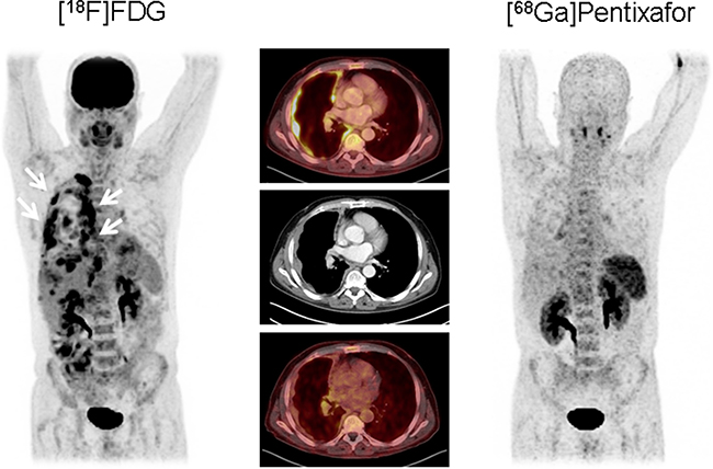 Example of epitheloid mesothelioma (patient #3) without relevant CXCR4 expression.