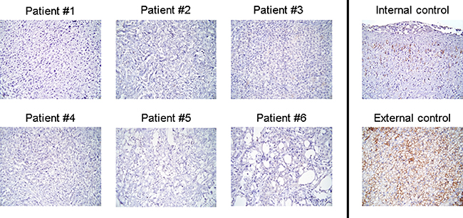 Individual IHC results for CXCR4.