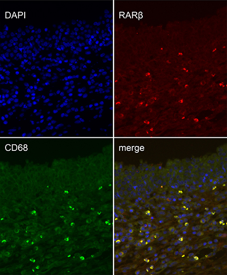 Double immunofluorescence of CD68 and RAR&#x03B2; in the prostatic wound.