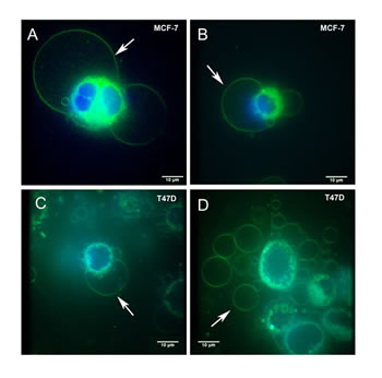 Live cell FM&reg; 1-43FX fluorescent imaging identifies giant vesicles in breast cancer cells.