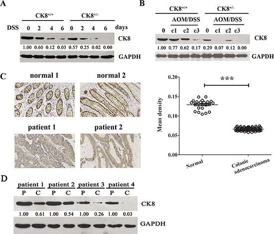 CK8 is down regulated in colitis and colitis-associated colorectal cancer.