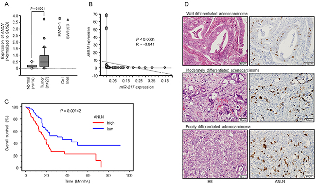Expression levels of ANLN mRNA and immunohistochemical staining of ANLN protein in PDAC specimens.