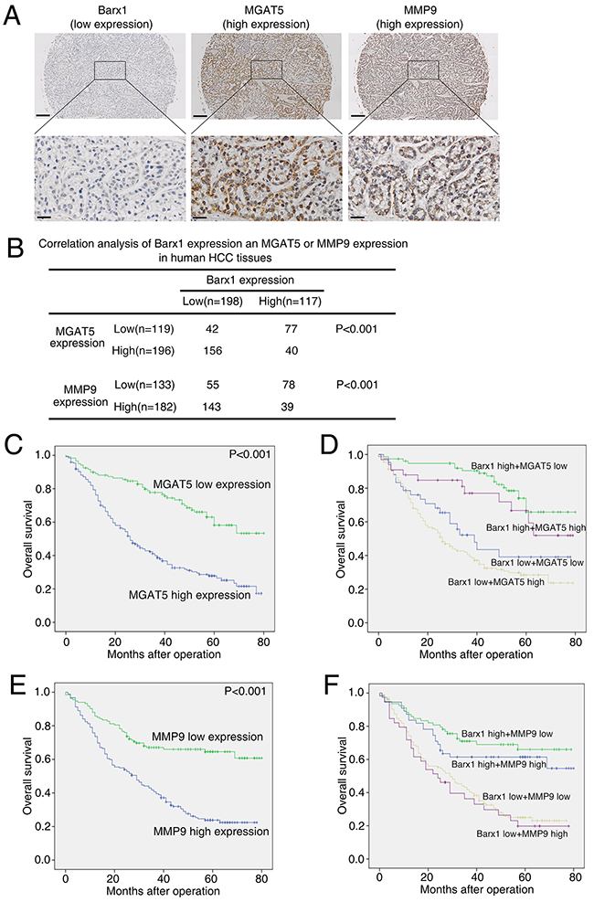 Barx1 expression is inversely correlated with MGAT5 and MMP9 expression in human HCC tissues.