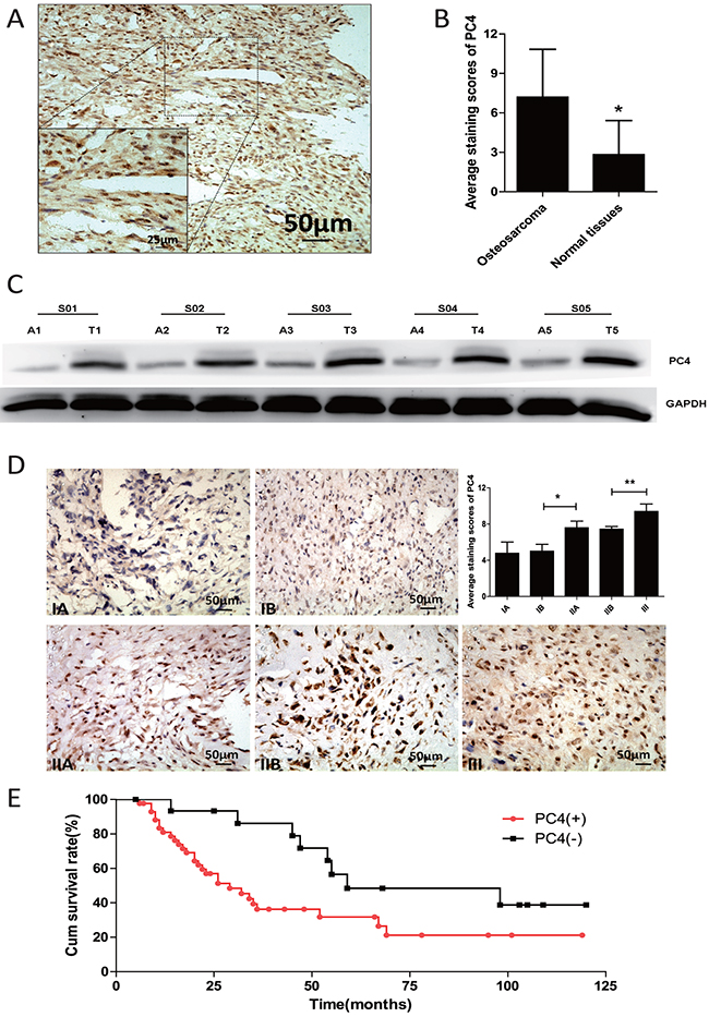 Increased expression of PC4 protein in osteosarcoma tissues.