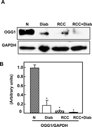 Fig 4: Significant accumulation of 8-oxodG and decreased in OGG1 protein in kidney cancer patients with diabetes.