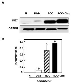 Fig 2: Overexpression of ki67 protein in kidney cancer patients with diabetes.