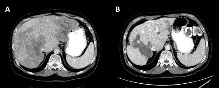 Abdominal CT with contrast (