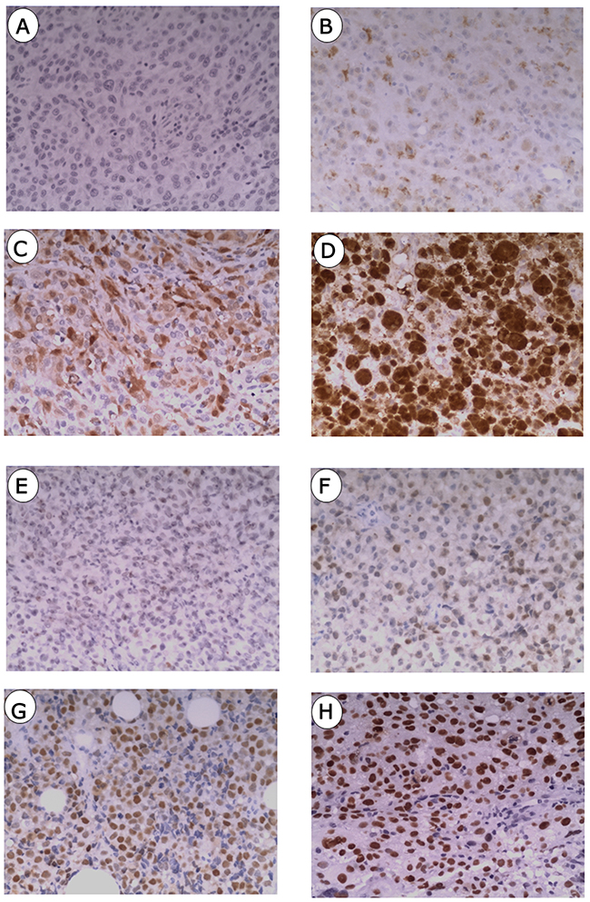 Immunostainings of p16 and p53 in mucosal melanoma.