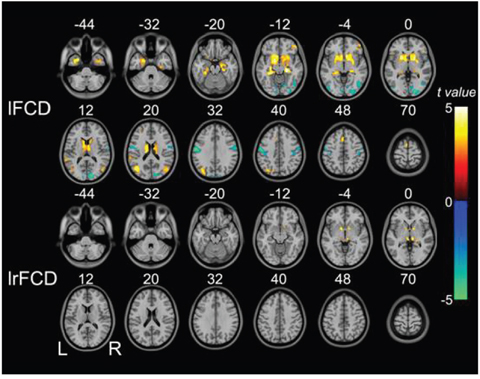 Brain regions in which lFCD and lrFCD differed significantly between schizophrenia patients and healthy controls.