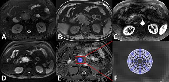 Apparent diffusion coefficient (ADC) measurements for pancreatic ductal adenocarcinoma at the head of the pancreas.