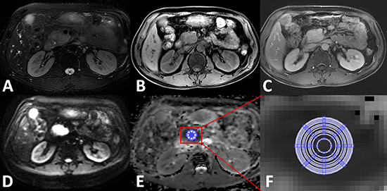 Apparent diffusion coefficient (ADC) measurements for mass-formed chronic pancreatitis at the head of the pancreas.