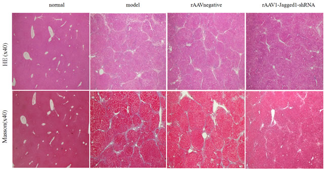Inhibition of Jagged1 expression reversed liver fibrosis.