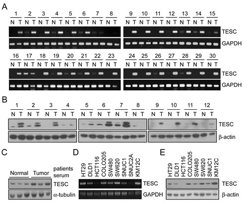 Increased mRNA and protein expression of TESC in human colorectal tissues, serum, and various CRC cell lines.