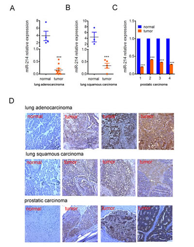 Figure 7:Inverse correlation of miR-214 and N-ras expression in lung and prostate cancers RT-qPCR quantification of miR-214 expression in human.
