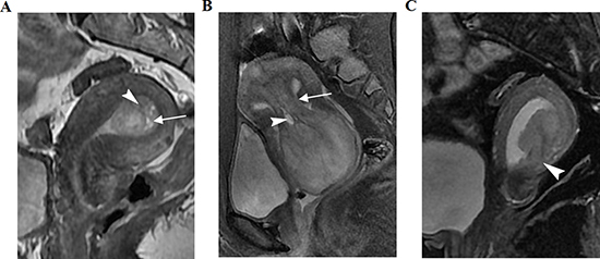 Three women with histopathologically proven uterine polyps, submucosal myoma, and stage I endometrial carcinoma, respectively, on sagittal T2-weighted imaging (T2WI).