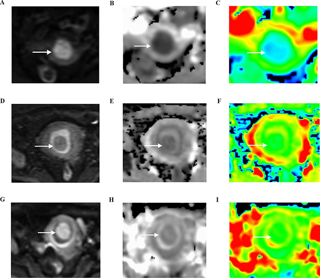 Three women with histopathologically proven stage I endometrial carcinoma, endometrial polyp, and a submucosal myoma, respectively, on axial diffusion-weighted imaging (DWI) and apparent diffusion coefficient (ADC) maps.