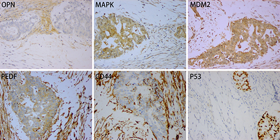 Positive expression for OPN, MAPK, MDM2, PDEF, CD44 and P53 in case 1.