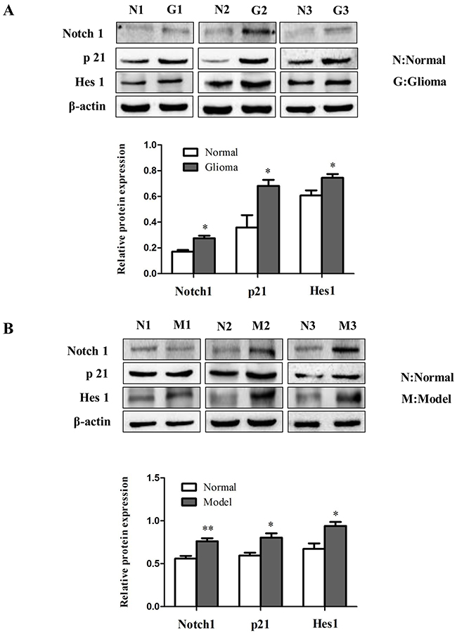 The role of Notch signaling in gliomas.