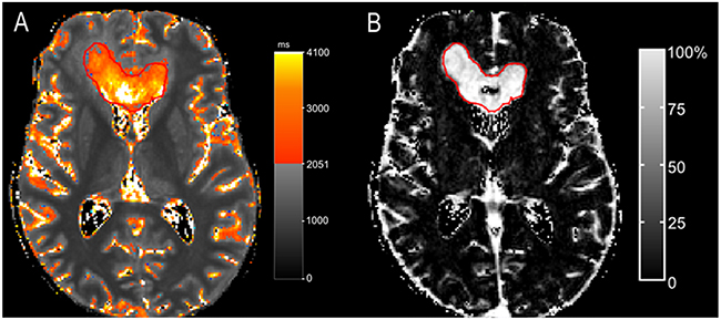 A patient with &#x003E;90% overlap (patient 2).