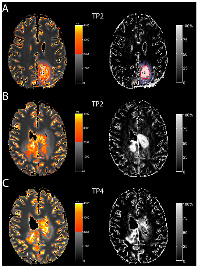 T1-prolongation &#x003E; 2051 ms outside the solid contrast-enhancing tumor