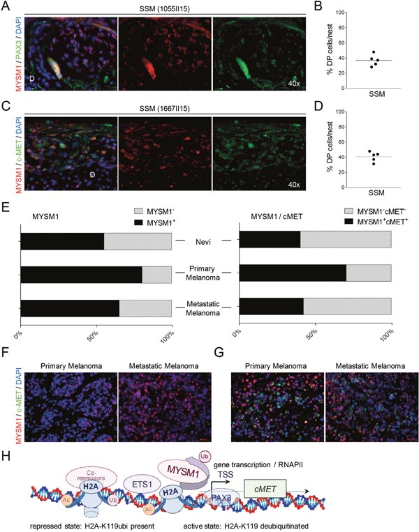 Co-localization of MYSM1 with PAX3 and c-MET in human SSM samples.