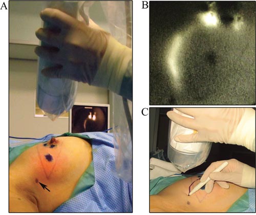 Marking the whole lymphatic vessels guided by ICG fluorescence.