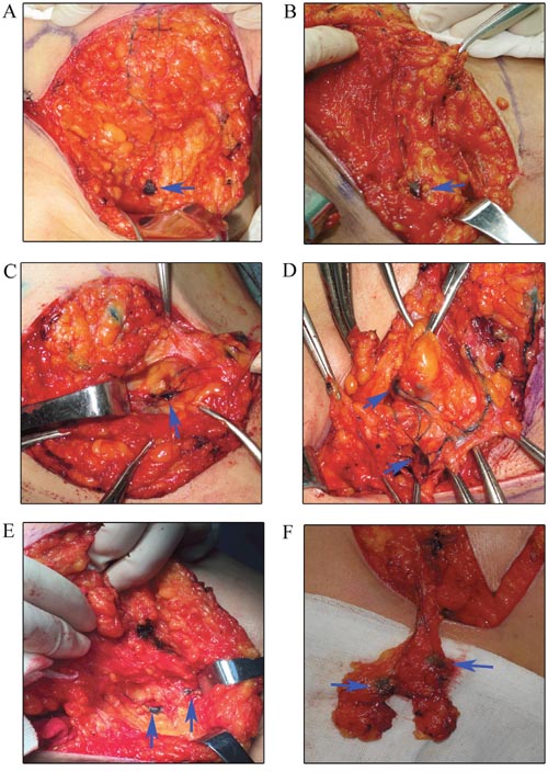 Identification the trSLNs with various input lymphatic ducts.